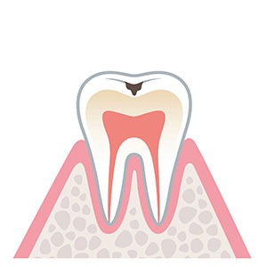 歯の表層のむし歯