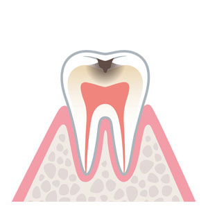 エナメル質の下にある象牙質まで到達したむし歯