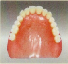 レジン床義歯(プラスチック)